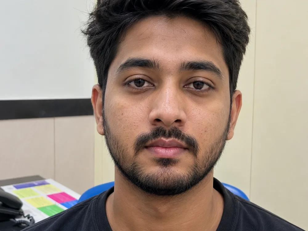 Acne & Scar Reduction
